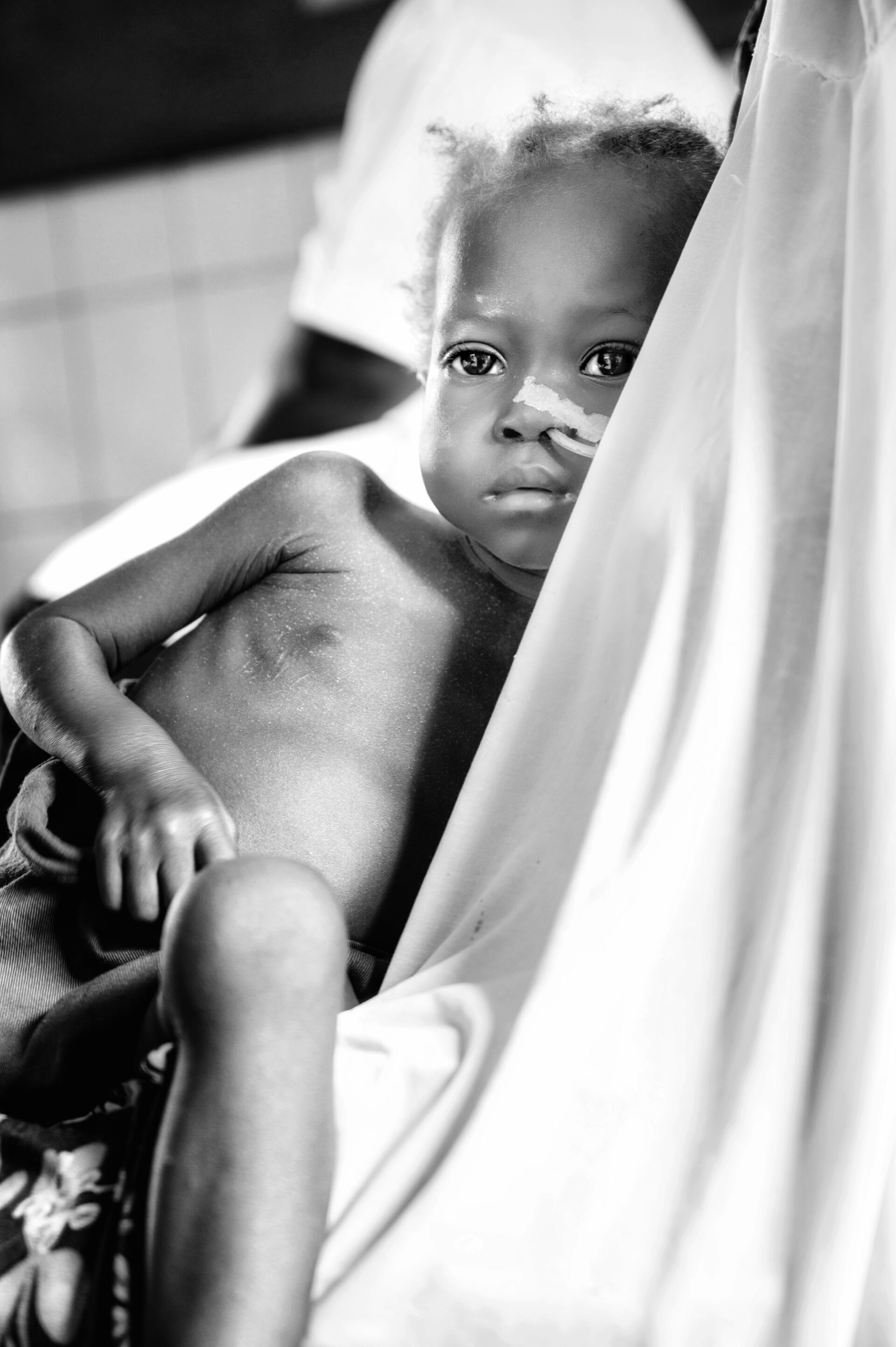 Enfant dénutrit soigné au CREN de Ouagadougou